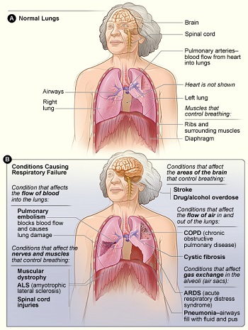 Condiciones que conducen a insuficiencia respiratoria