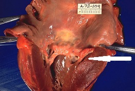 Estenosis de la válvula mitral causada por cardiopatía reumática