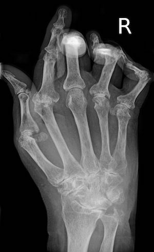 Artritis reumatoide