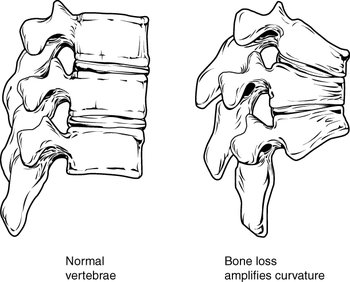 Columna vertebral osteoporosis