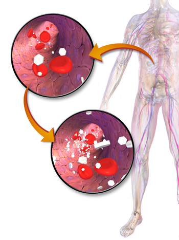 Hiperglucemia
