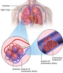 Embolia pulmonar