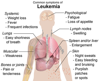 Leucemia