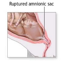 Imagen de saco amniótico roto 