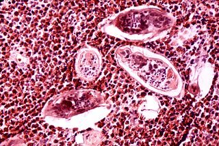 Los huevos de esquistosoma se encuentran durante la biopsia de vejiga.