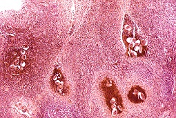 Células de la vejiga examinadas después de una cistoscopia