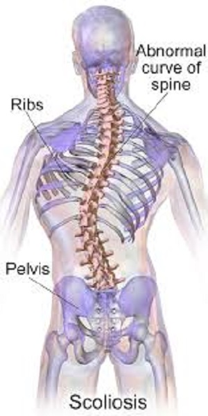 escoliosis
