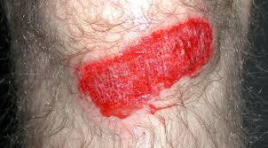 rodilla raspada