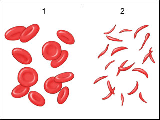 Glóbulos rojos normales vs. Células sanguíneas de una persona que padece anemia falciforme