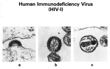 Infección por VIH