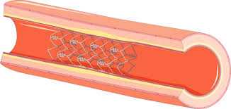 stent