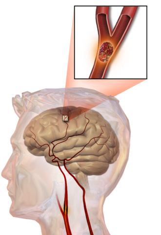 Los coágulos de sangre son una causa común de accidentes cerebrovasculares isquémicos