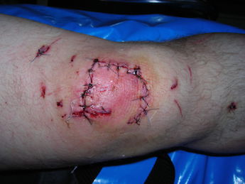 Suturas de rodilla infectadas