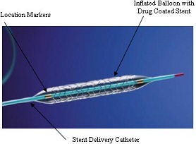 Stent colocado con globo