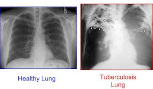tuberculosis pulmonar