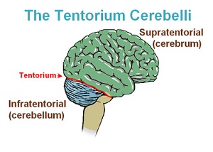 hernia cerebral a través del tentorio