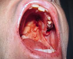 extracción dental