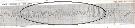 Torsades de pointes es un ritmo mortal