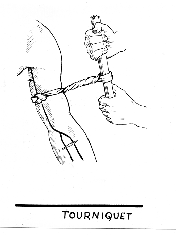 Imagen de un torniquete. 