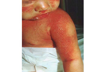 Ejemplo de choque tóxico en un bebé