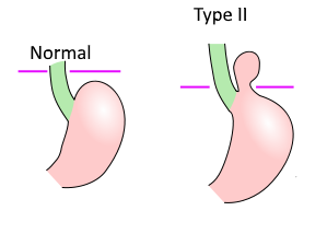 hernia tipo 2