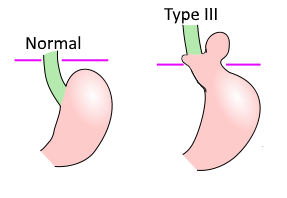 hernia tipo 3