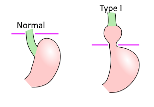 hernia tipo 1