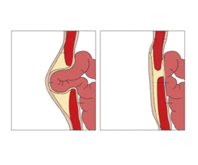 hernia umbilical