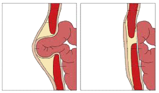 Diagrama de una hernia umbilical