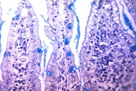 Células examinadas después de una biopsia