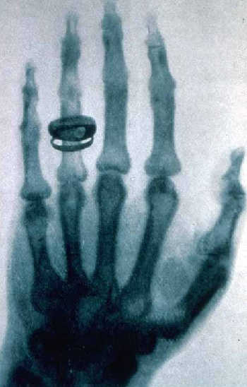 Una radiografía tomada por Wilhelm Roentgen