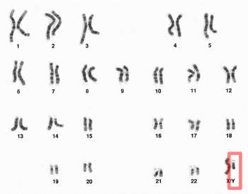 Determinación del sexo XY en humanos