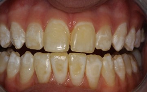 La tetraciclina hace que los dientes se pongan amarillos.
