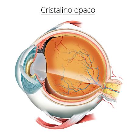 ¿Qué son las Cataratas en los Ojos?